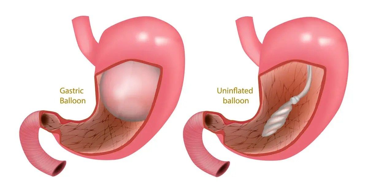 Double Balloon Enteroscopy