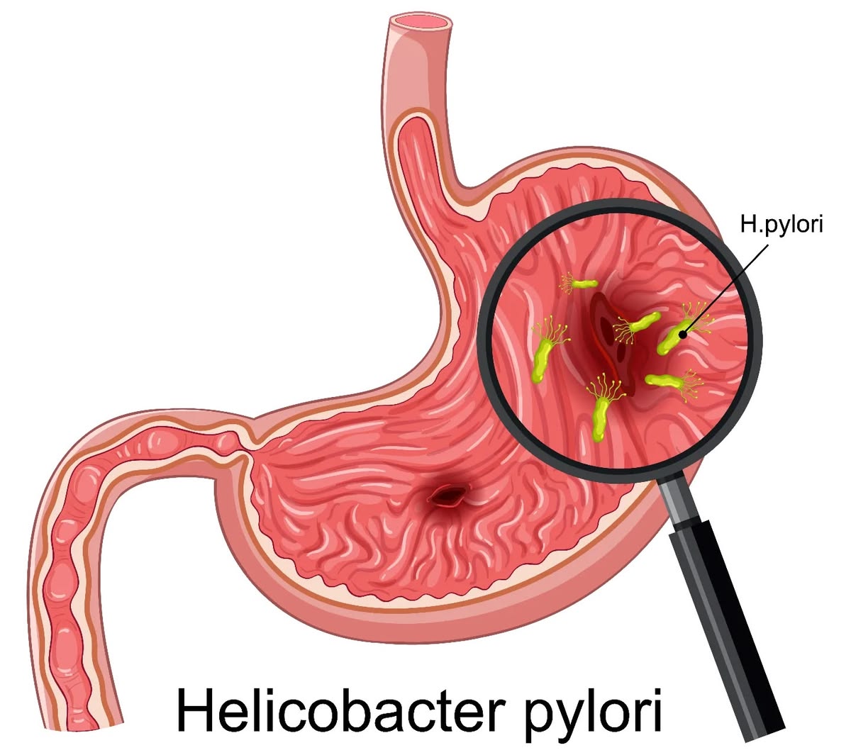 Acid Reflux GERD