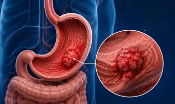 Acid Reflux GERD