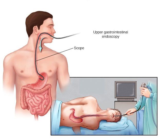 Upper GI Endoscopy in South Delhi